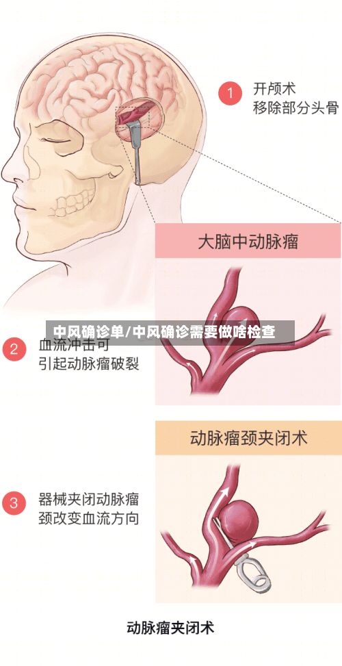 中风确诊单/中风确诊需要做啥检查-第2张图片