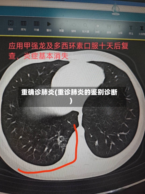 重确诊肺炎(重诊肺炎的鉴别诊断)