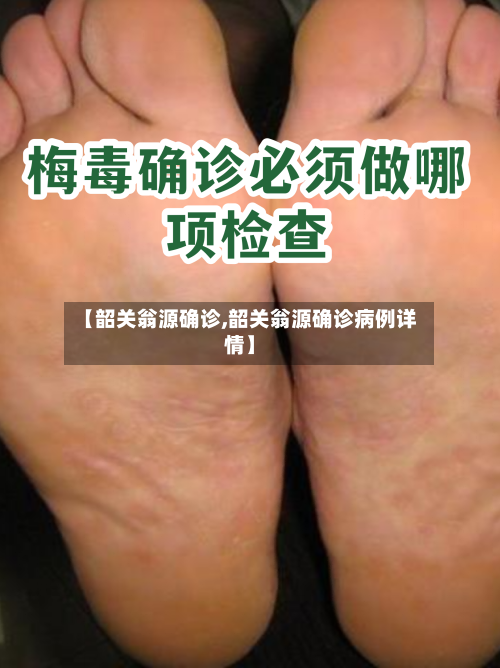 【韶关翁源确诊,韶关翁源确诊病例详情】-第3张图片