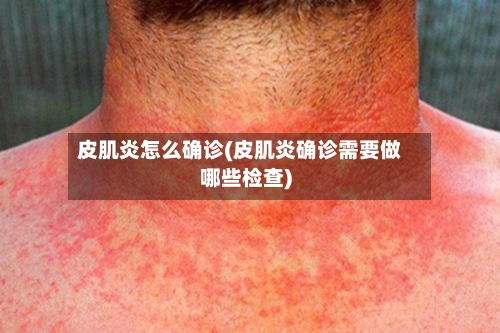 皮肌炎怎么确诊(皮肌炎确诊需要做哪些检查)-第3张图片