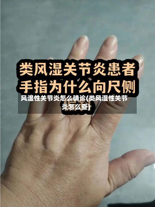 风湿性关节炎怎么确诊(类风湿性关节炎怎么查)