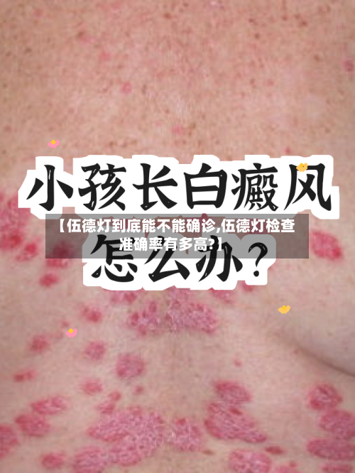 【伍德灯到底能不能确诊,伍德灯检查准确率有多高?】