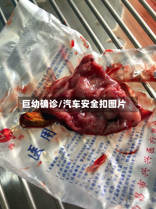 巨幼确诊/汽车安全扣图片-第2张图片