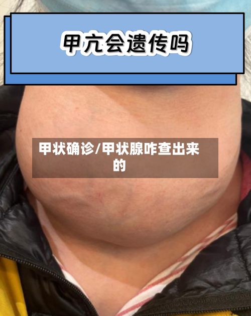 甲状确诊/甲状腺咋查出来的-第2张图片