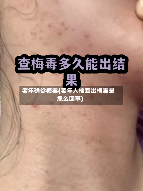 老年确诊梅毒(老年人检查出梅毒是怎么回事)