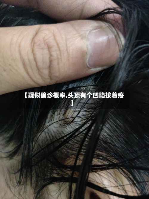 【疑似确诊概率,头顶有个凹陷按着疼】
