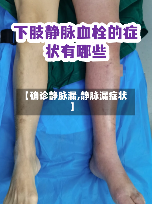 【确诊静脉漏,静脉漏症状】
